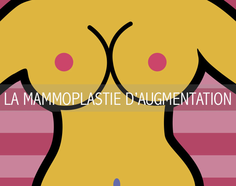 LA MAMMOPLASTIE D’AUGMENTATION