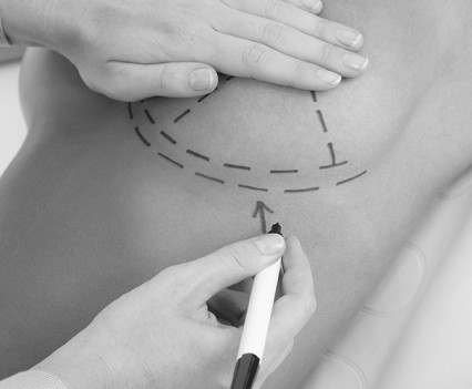 Plastic surgery doctor draw line patient breast