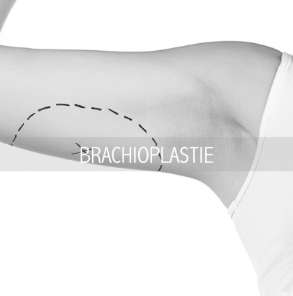 LA BRACHIOPLASTIE