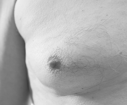 La gynécomastie permet de réduire l'excès de poitrine chez les hommes